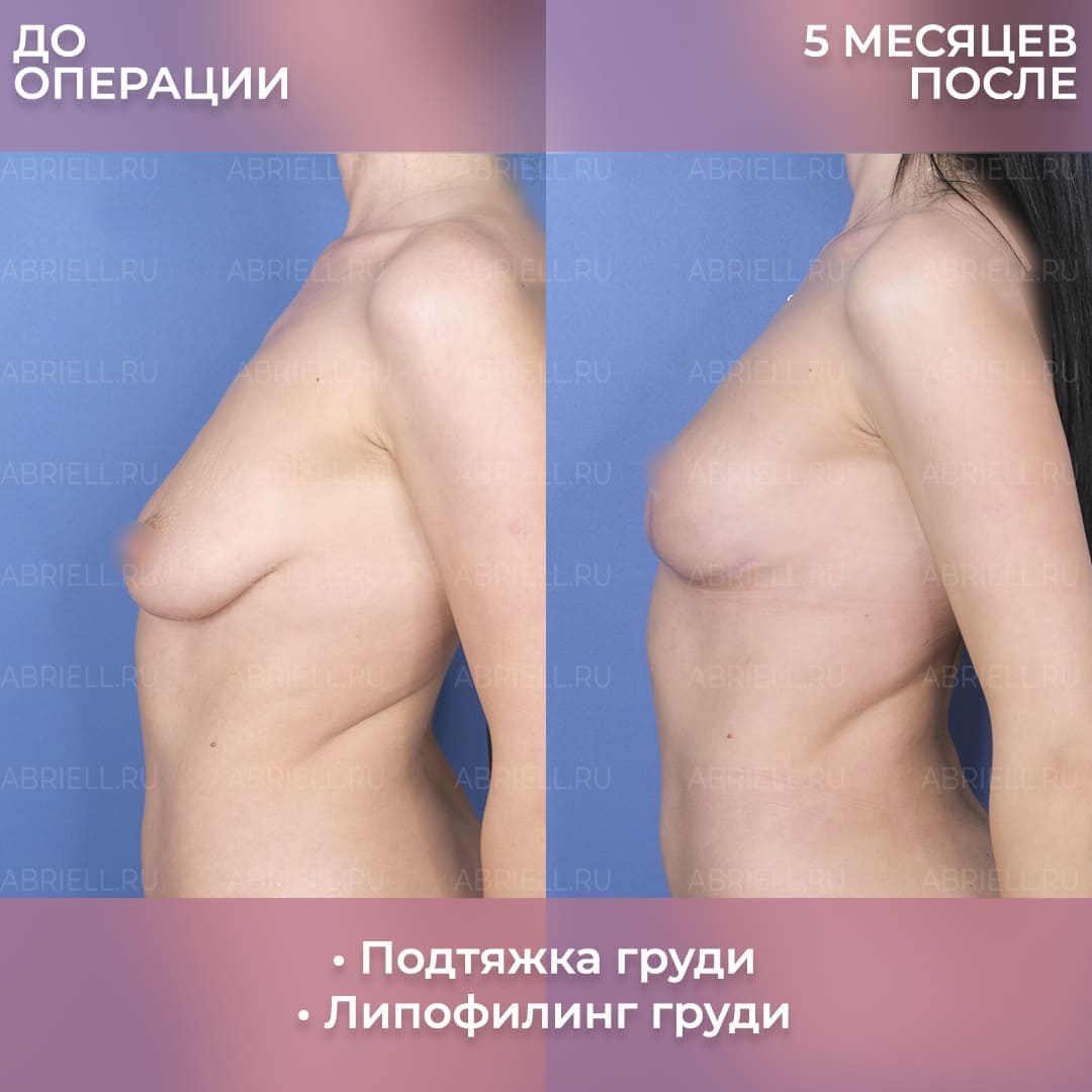 подтяжка груди с гантелями для женщин фото 16