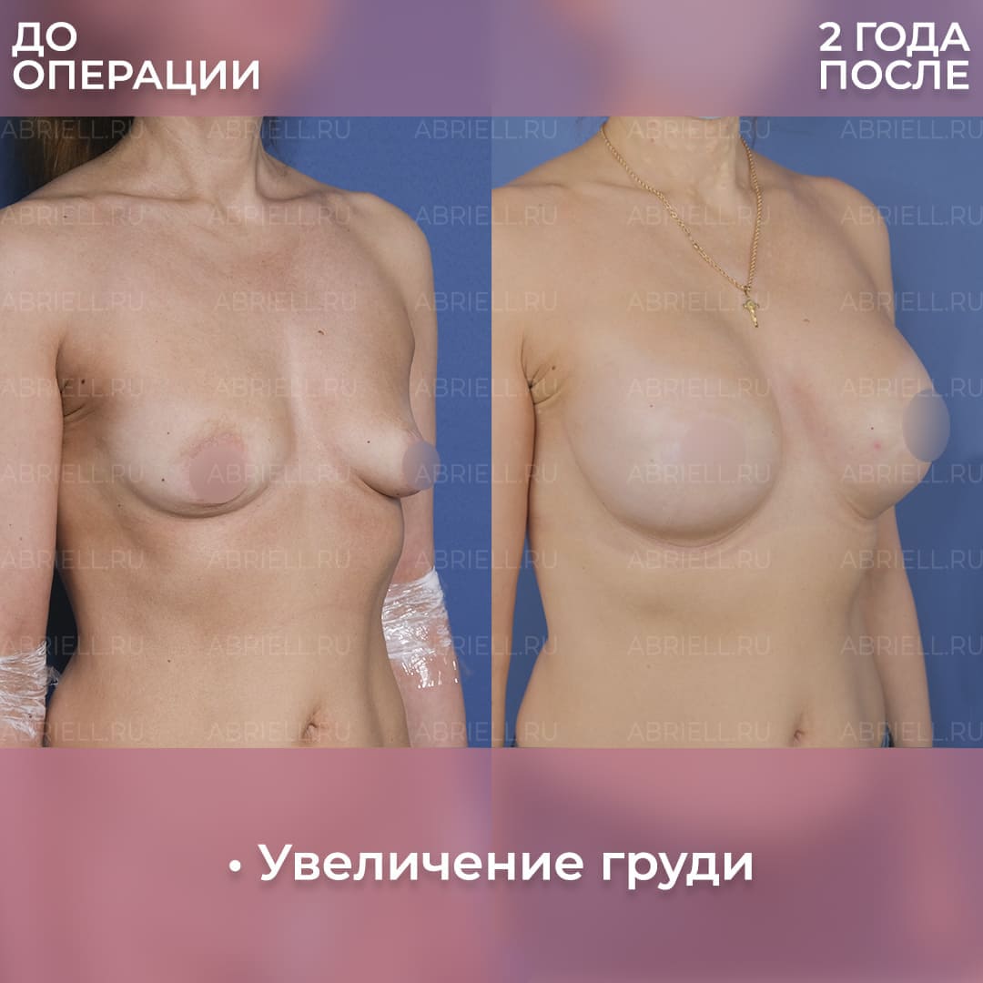 Фото после имплантации груди