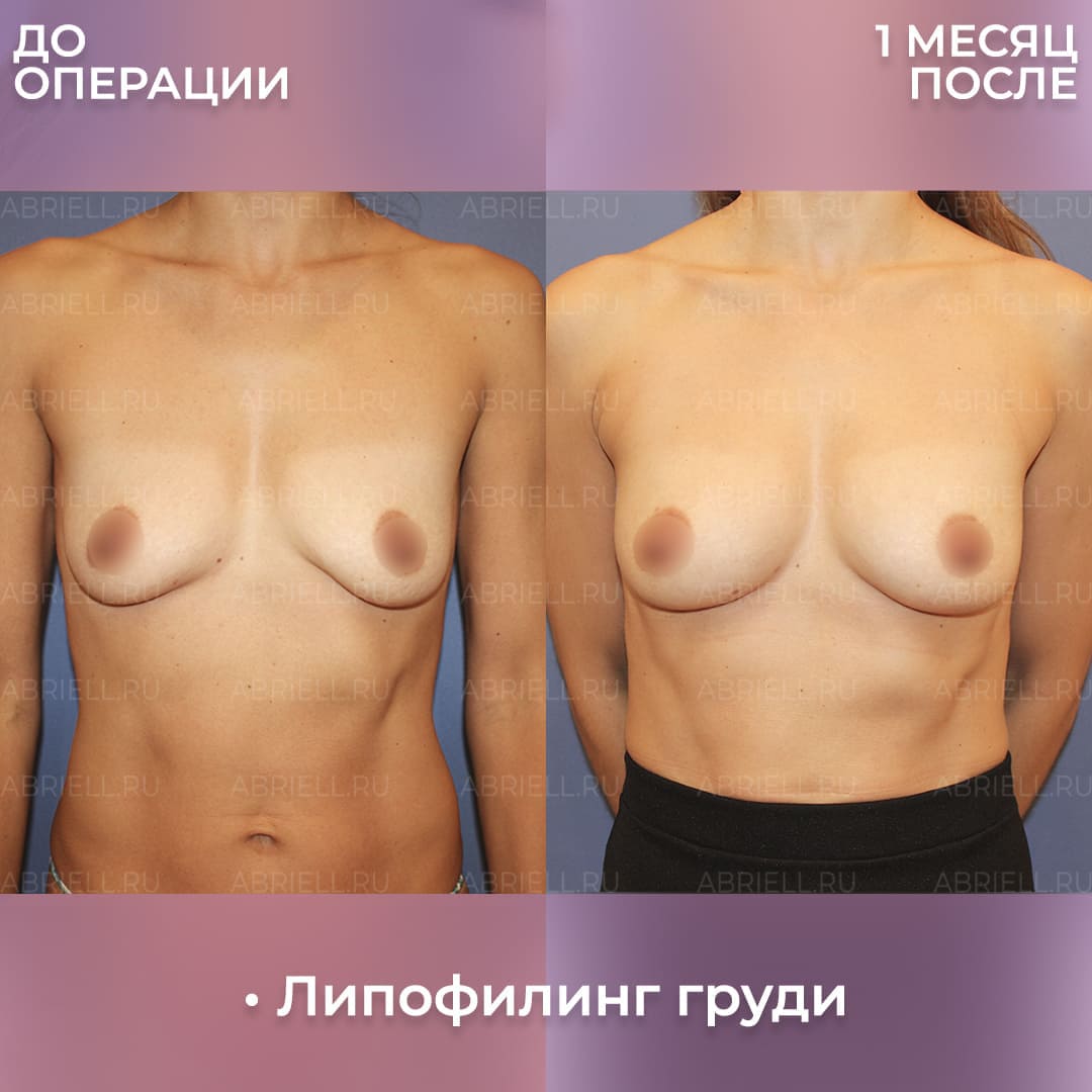 грудь 2 размера без операции фото 14