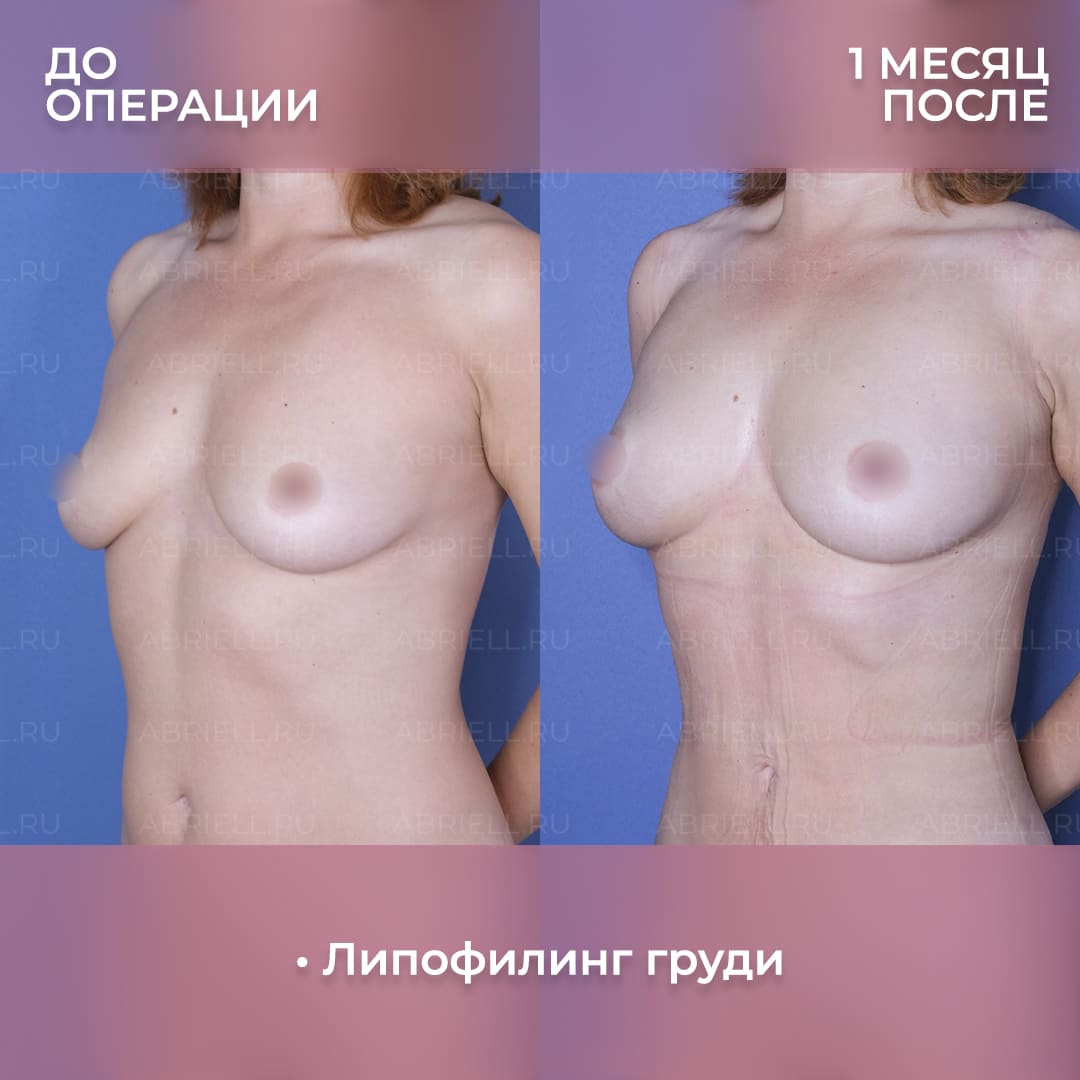 Фото после операции по увеличению груди
