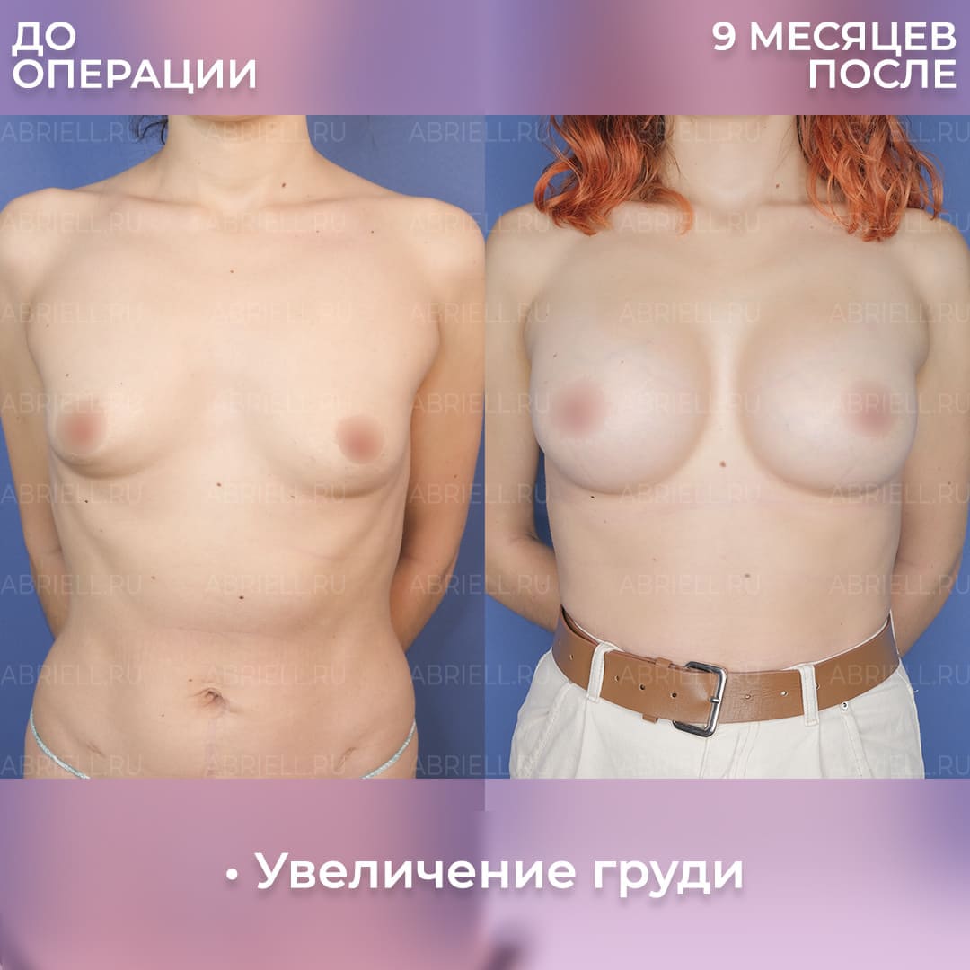 отзывы женщин о подтяжке груди фото 56