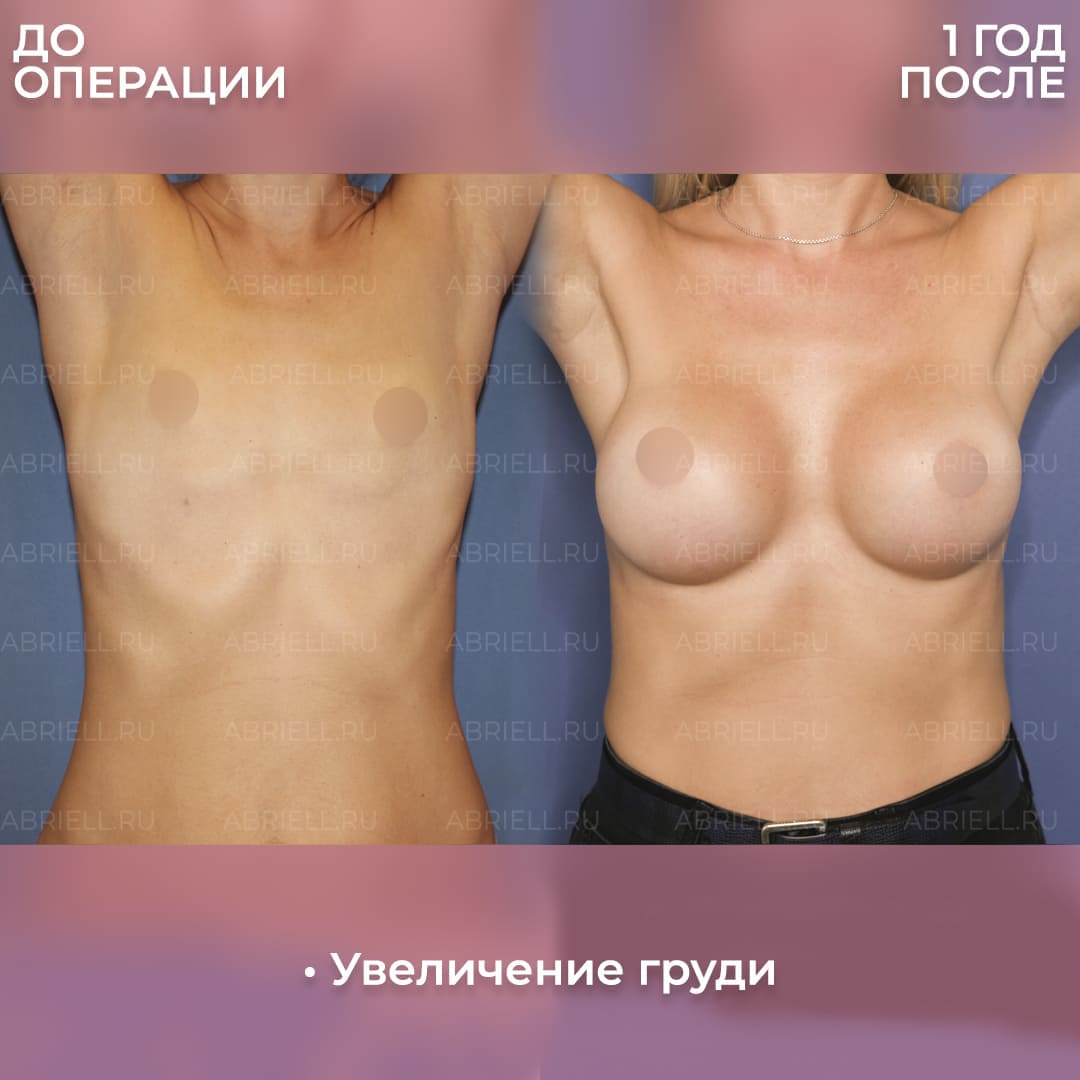 До и после эндопротезирования груди