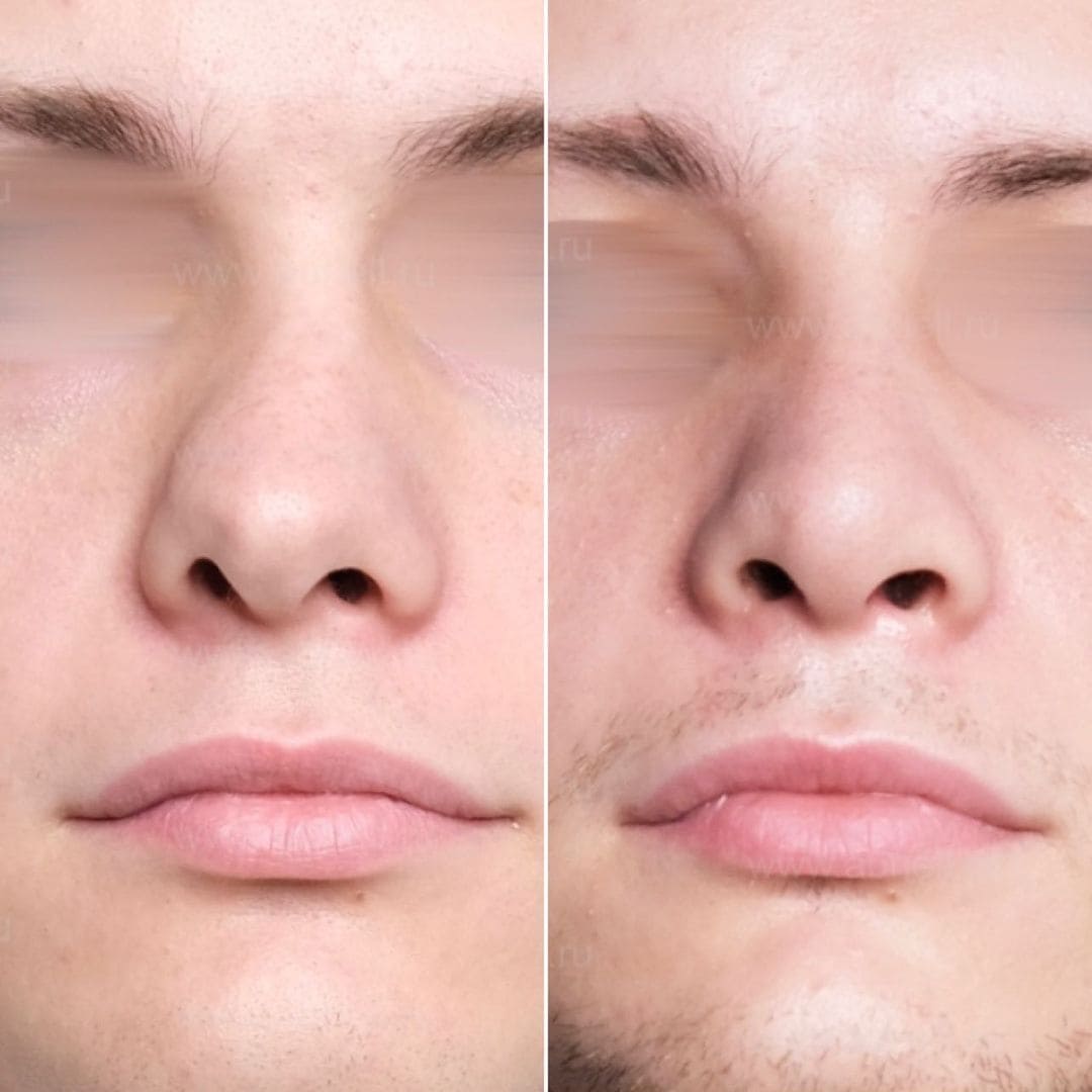 Фото после пластики носа у мужчин