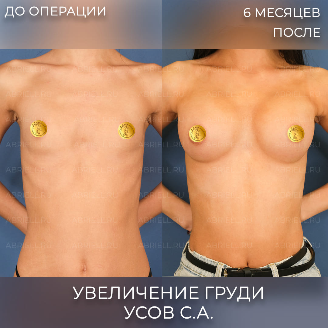 Фото после увеличения груди имплантами