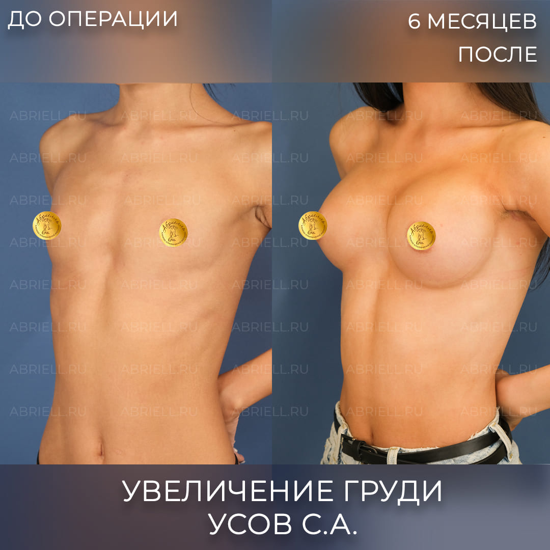 Фото до и после увеличения груди имплантами