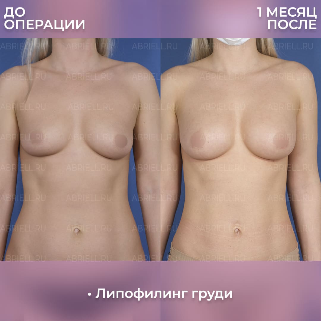 Фото после увеличения груди