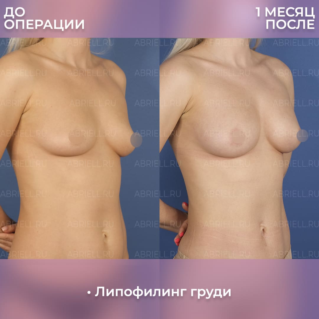 Результаты липофилинга груди