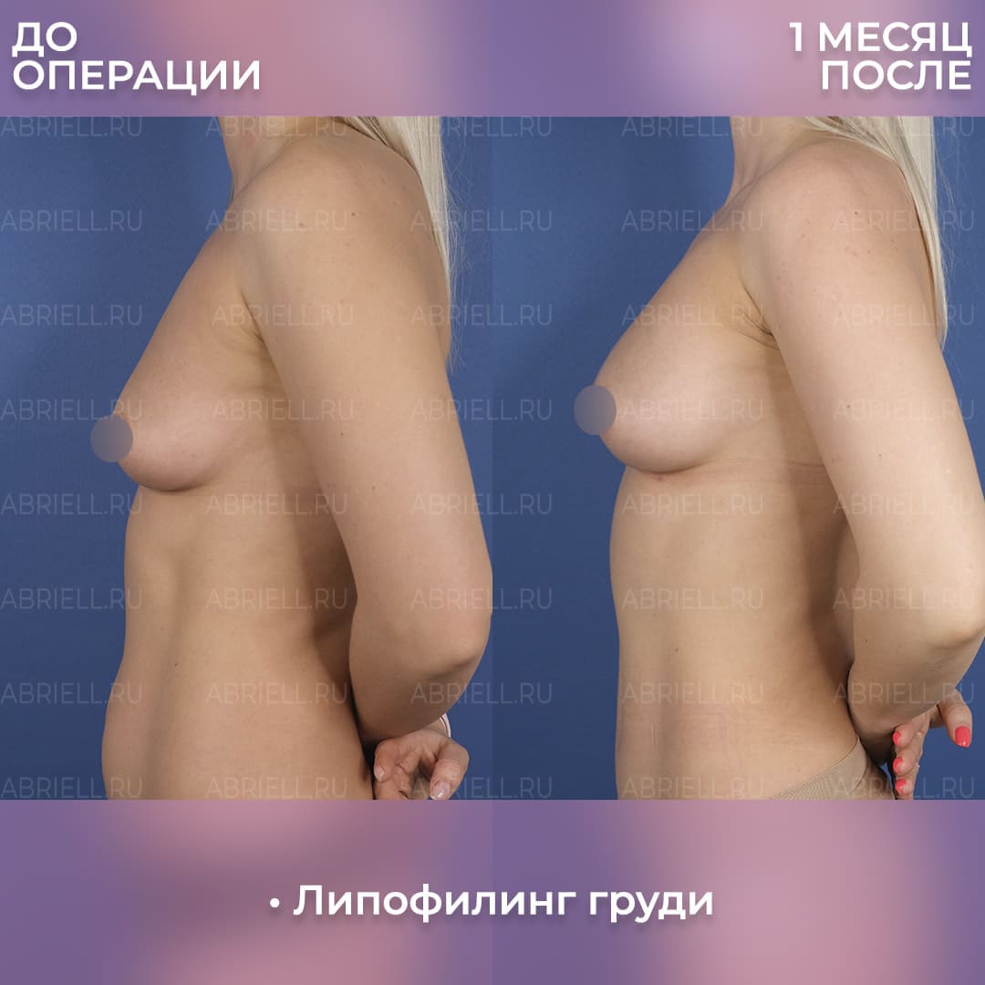 До и после липофилинга груди жиром