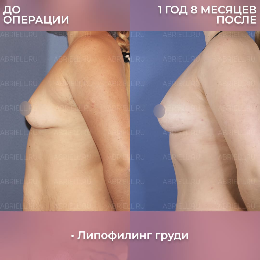 До и после липофилинга груди жиром