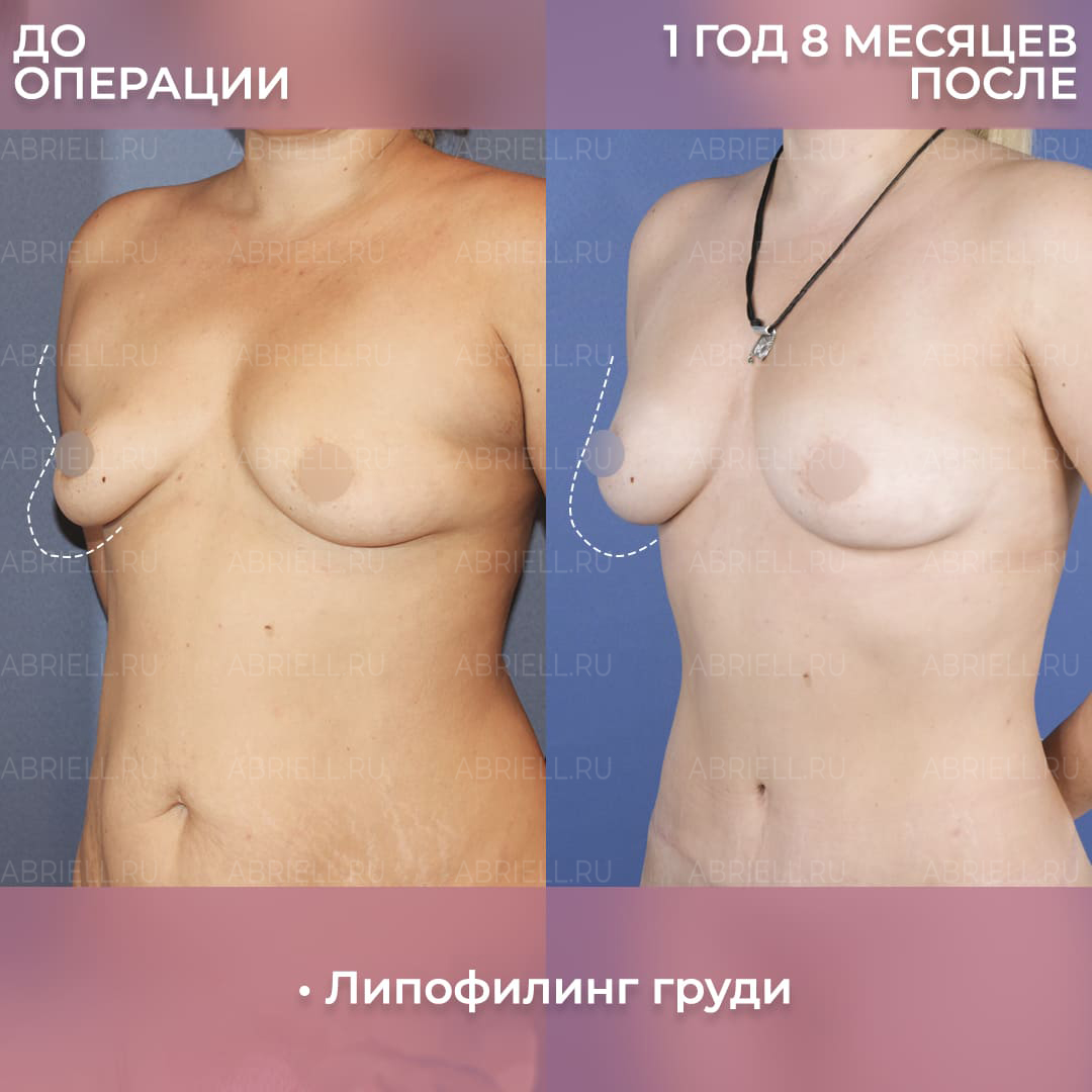 Фото до и после увеличения груди жиром