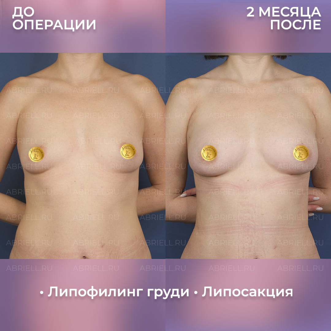 Фото после увеличения груди липофилингом