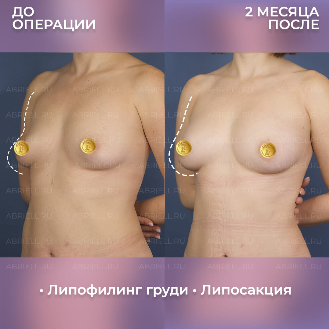 До и после увеличения груди липофилингом