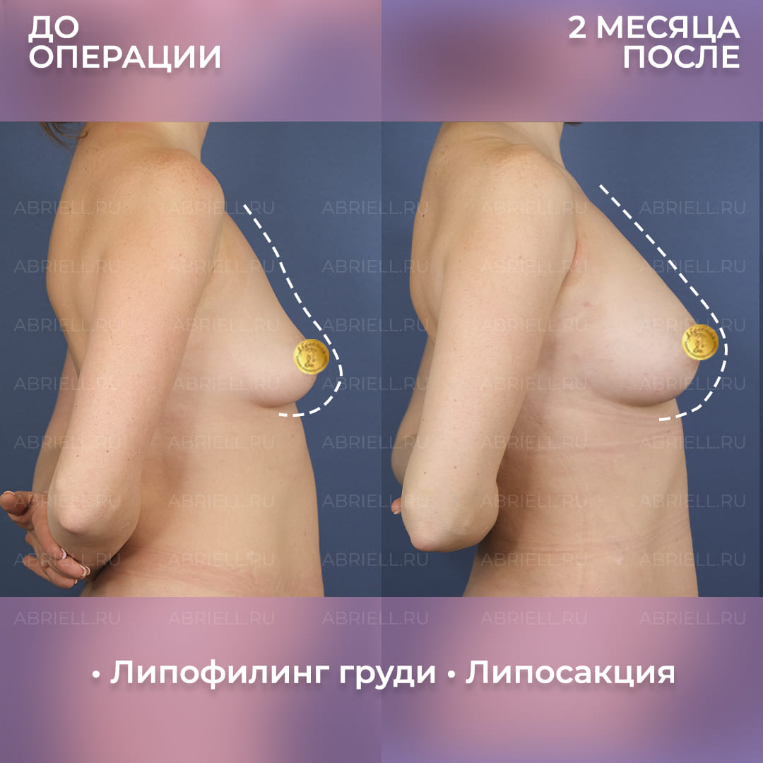 Фотографии увеличения груди липофилингом