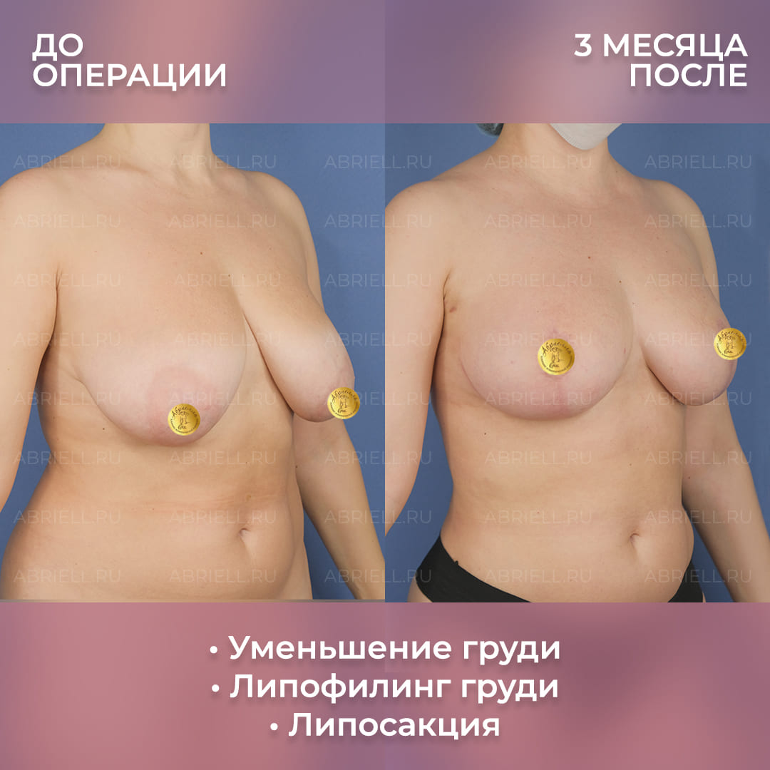 Фото после уменьшения груди