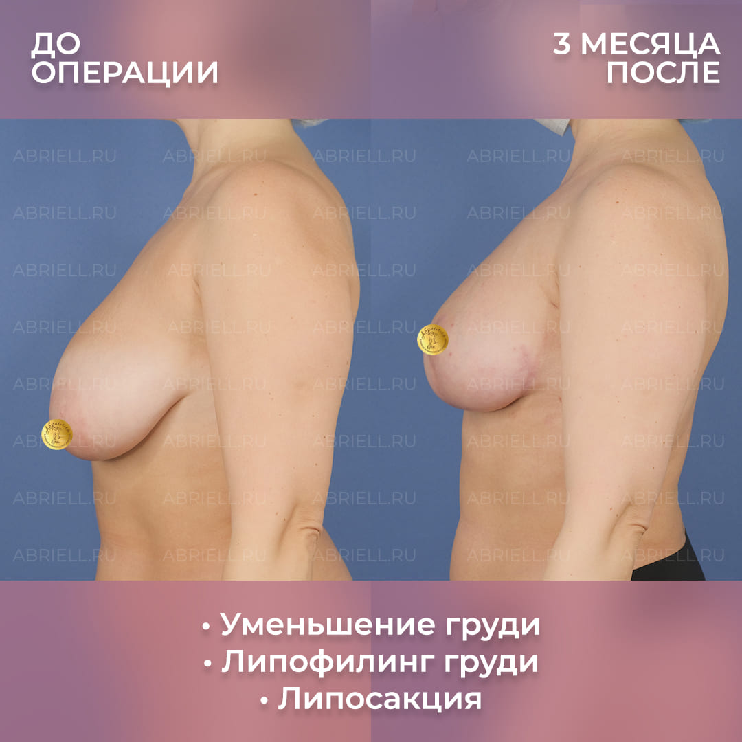 Фото уменьшения груди операцией