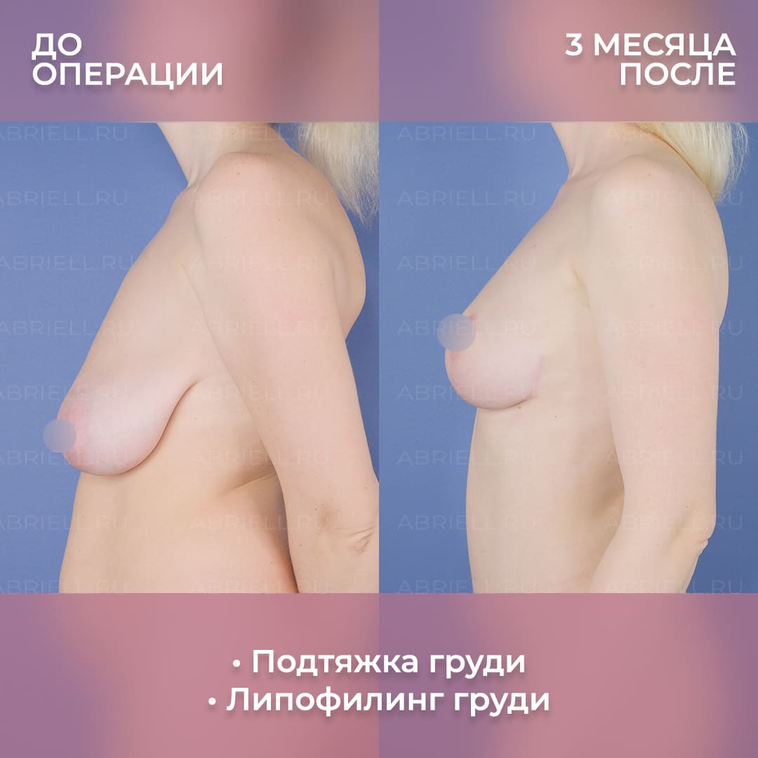 упражнения на уменьшение груди у женщин фото 12