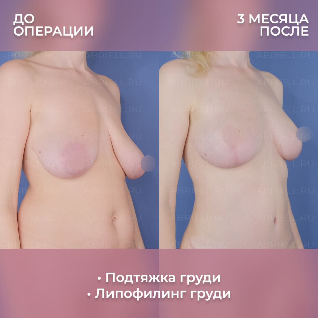 Результаты уменьшения груди с подтяжкой