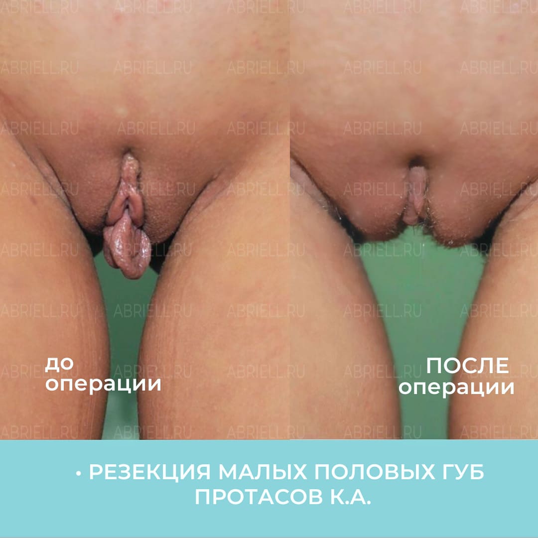 Резекция половых губ