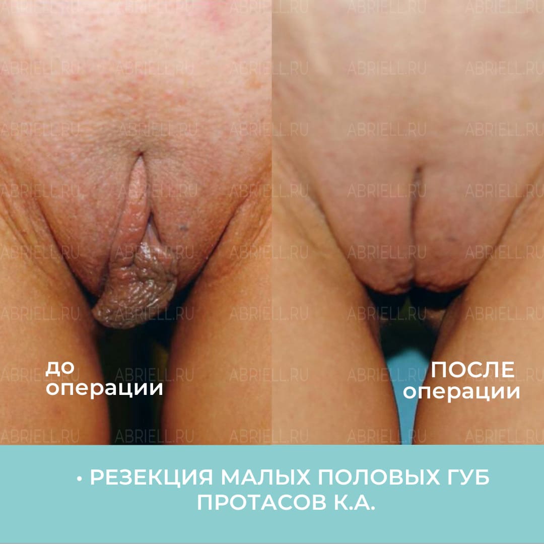 Уменьшение половых губ операцией