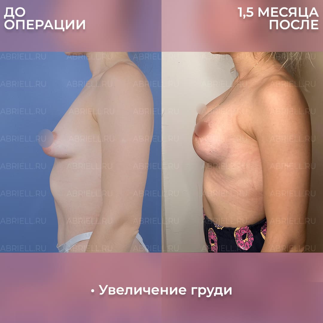 увеличилась грудь у женщин фото 6