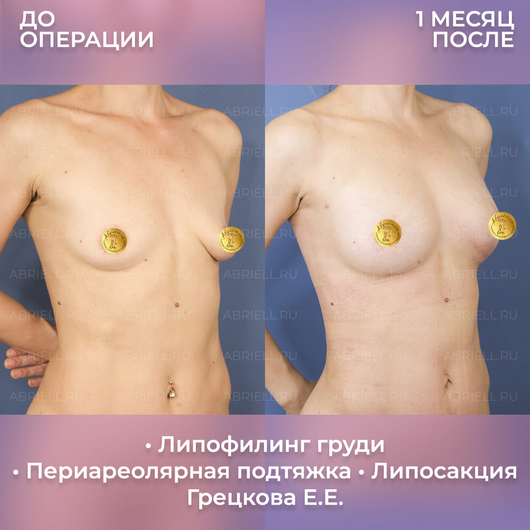 Фото до и после увеличения груди без имплантов
