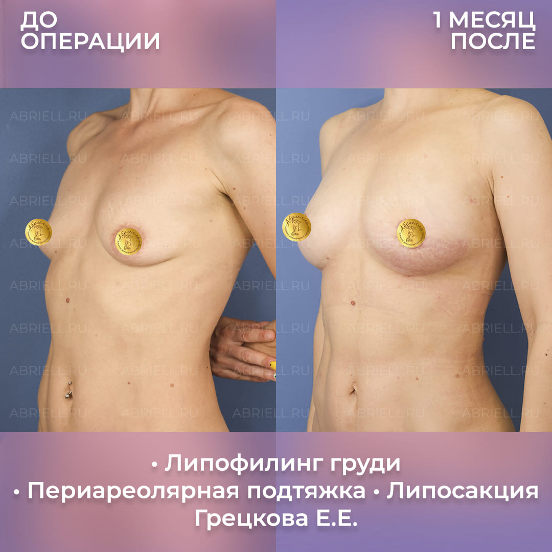 Результаты увеличения груди без имплантов