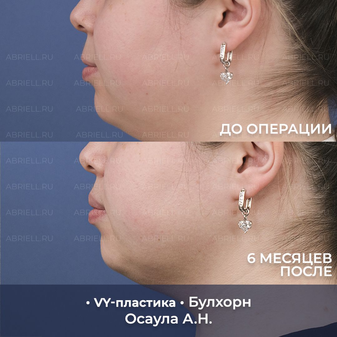 VY пластика и Булхорн