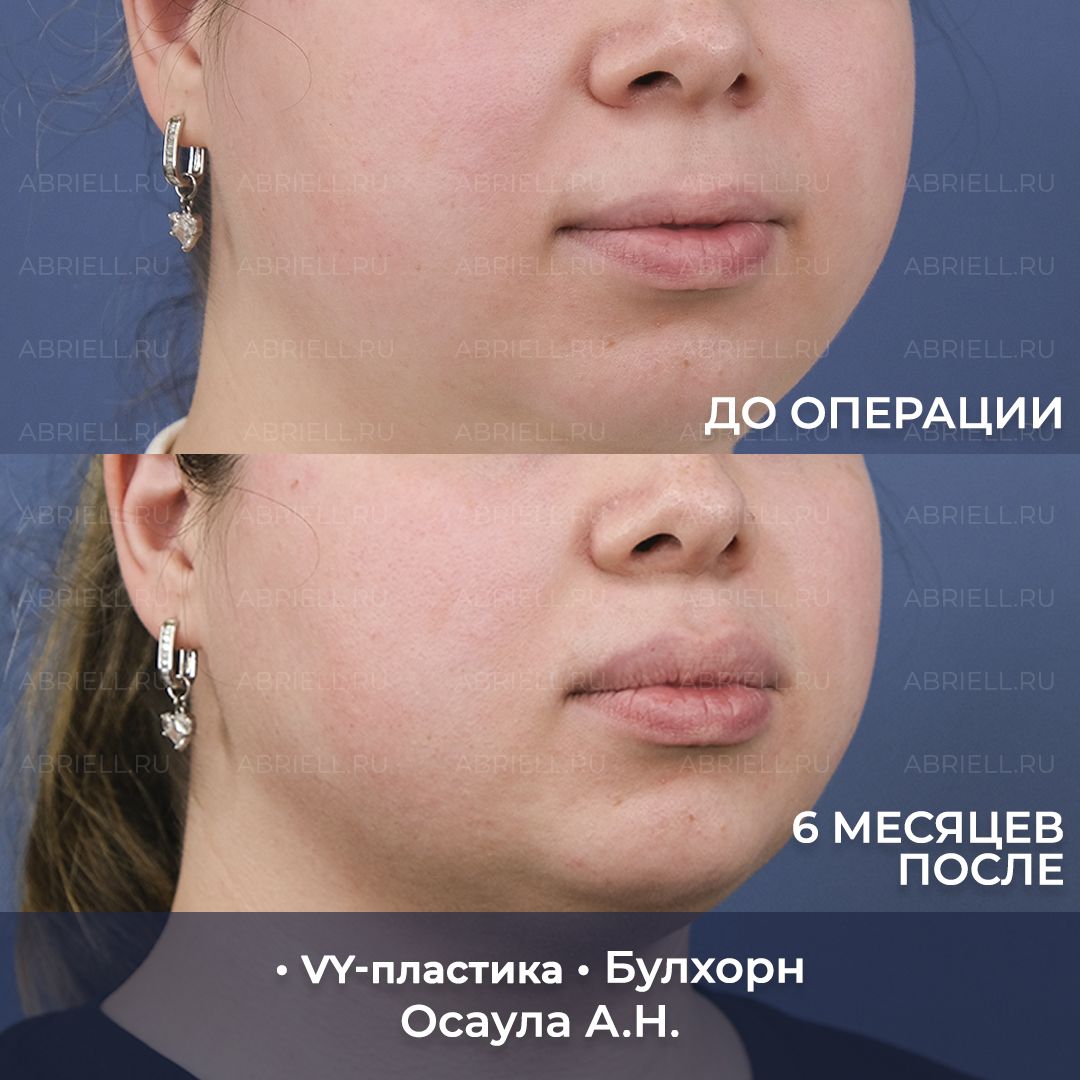 VY пластика и Булхорн