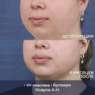 VY пластика и Булхорн