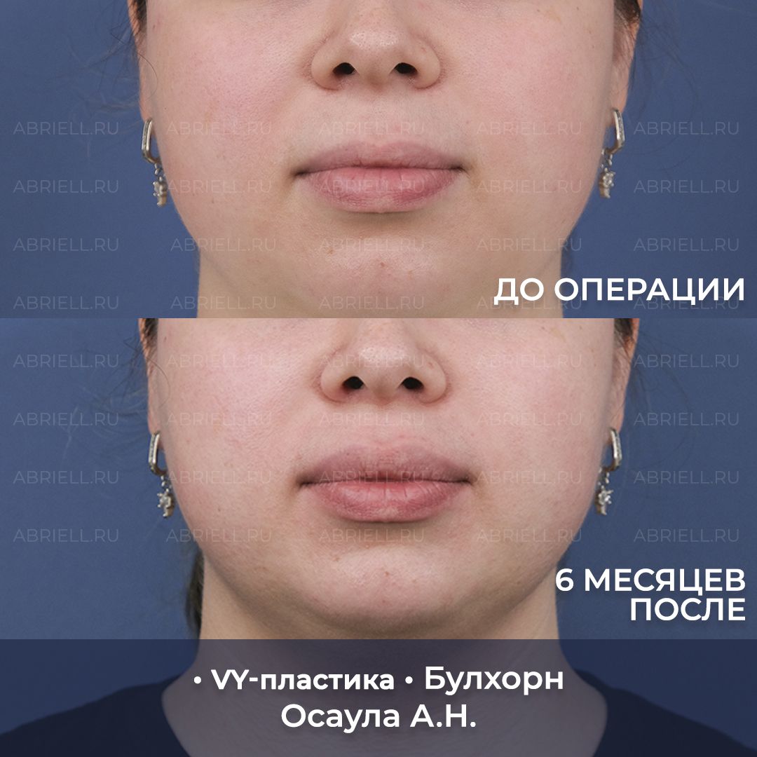 VY пластика и Булхорн