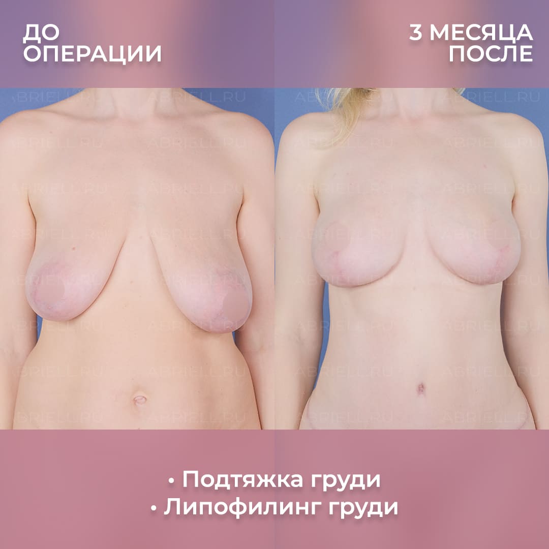 коррекция размера одной груди фото 2