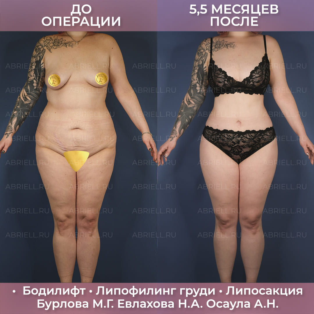 Комплексный бодилифт