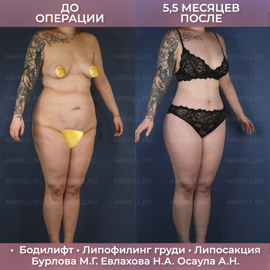 Комплексный бодилифт