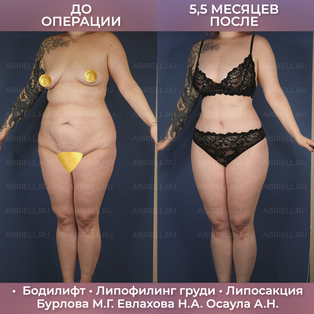 Комплексный бодилифт
