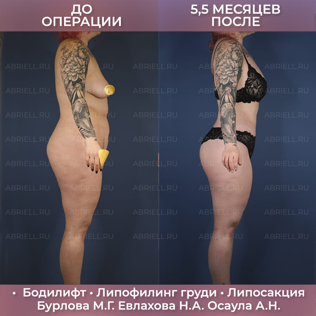 Комплексный бодилифт