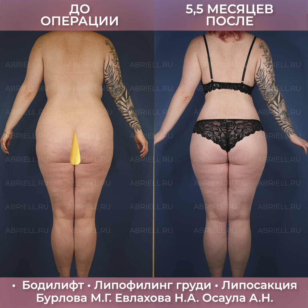Комплексный бодилифт
