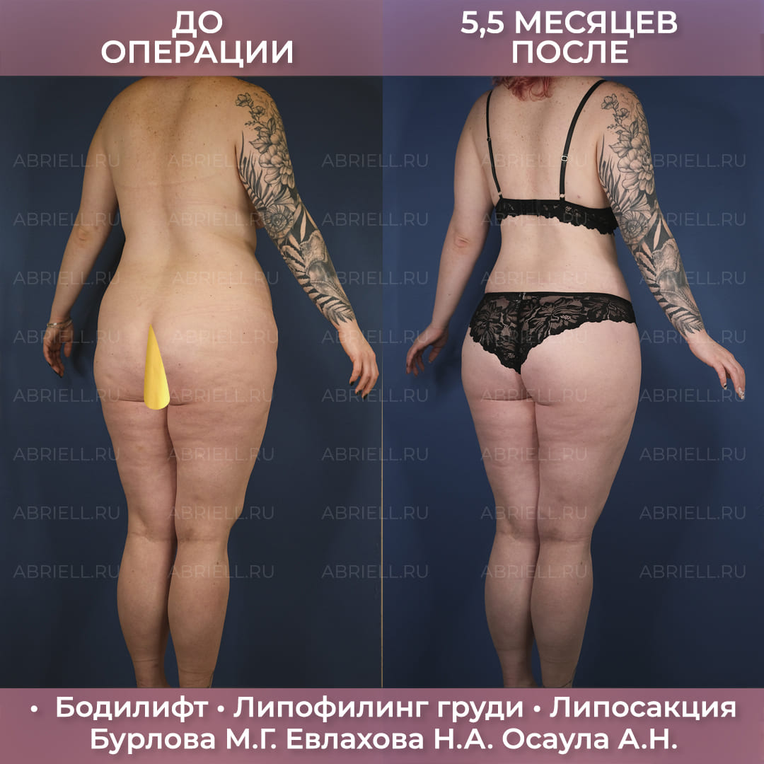 Комплексный бодилифт