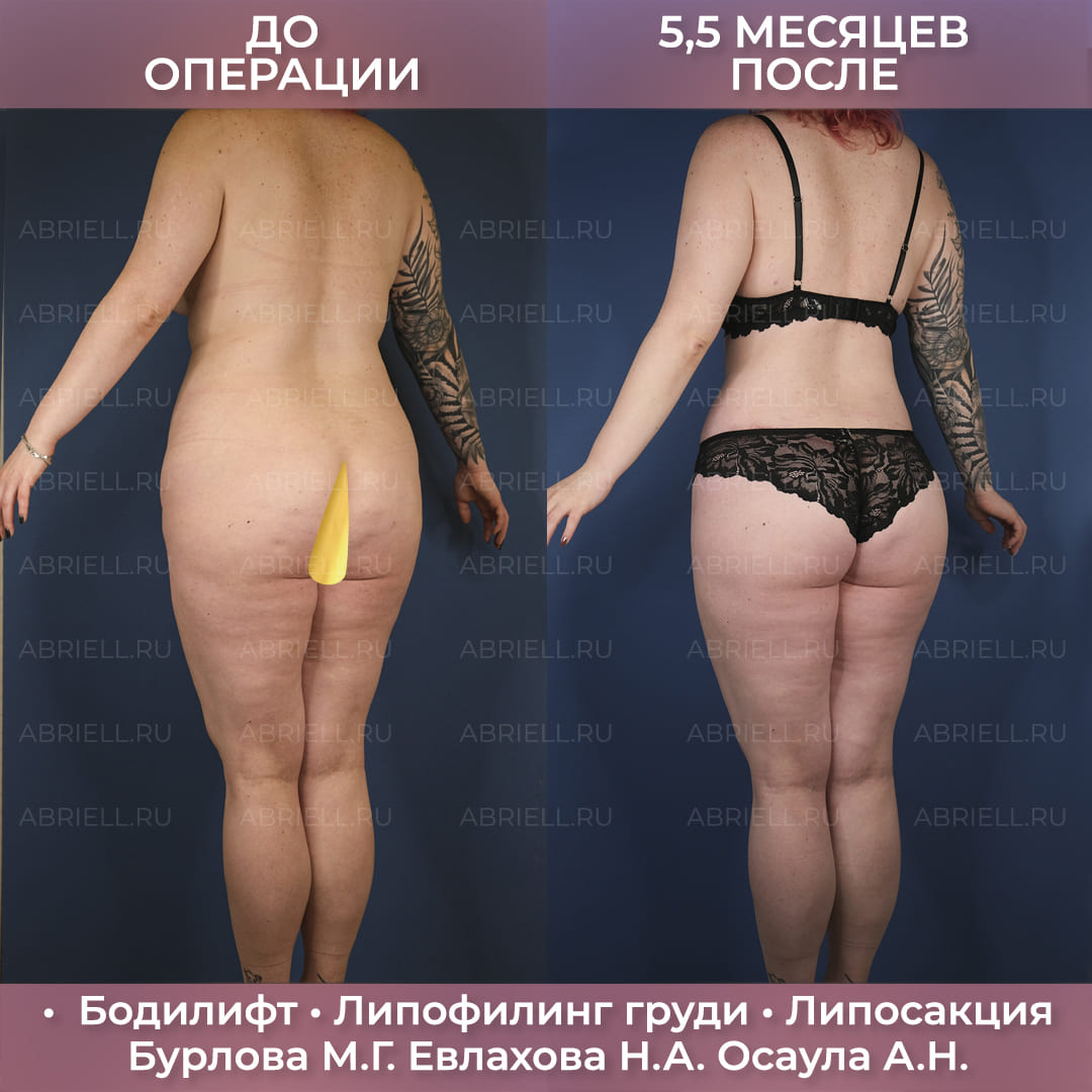 Комплексный бодилифт