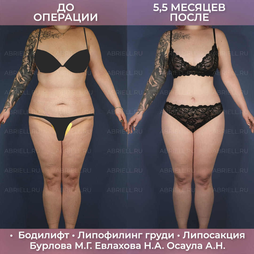 Комплексный бодилифт