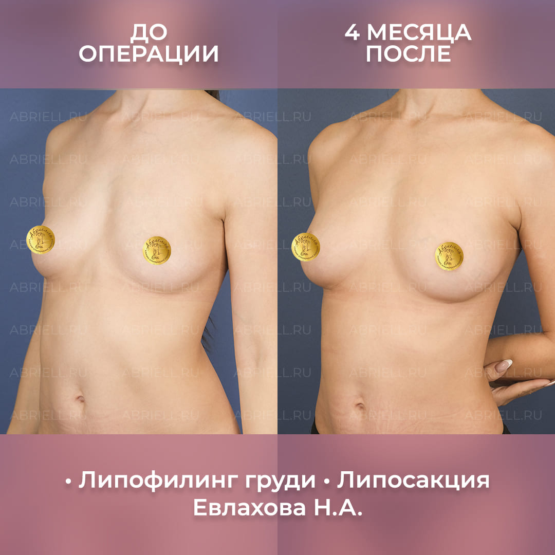 результаты липофилинга и липосакции