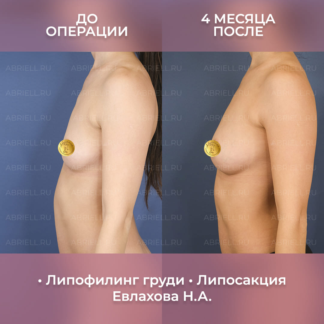 результаты липофилинга и липосакции