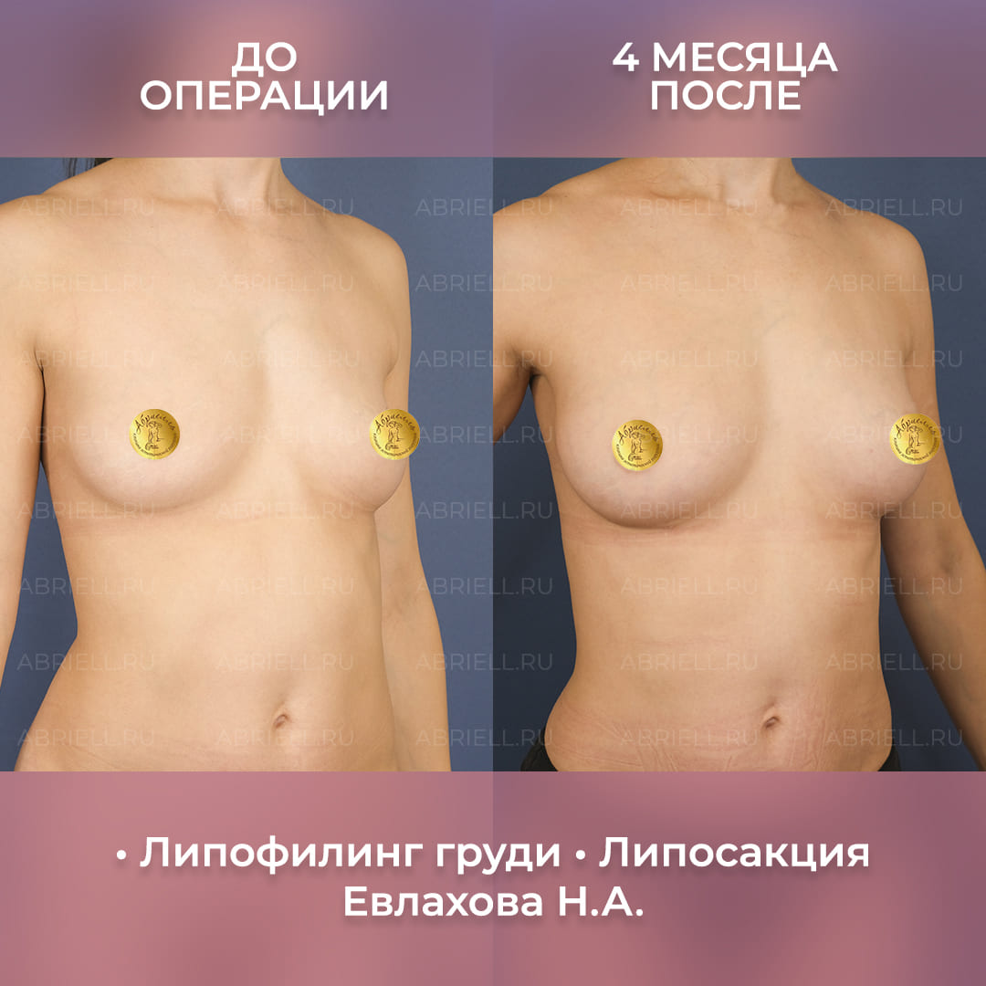 результаты липофилинга и липосакции