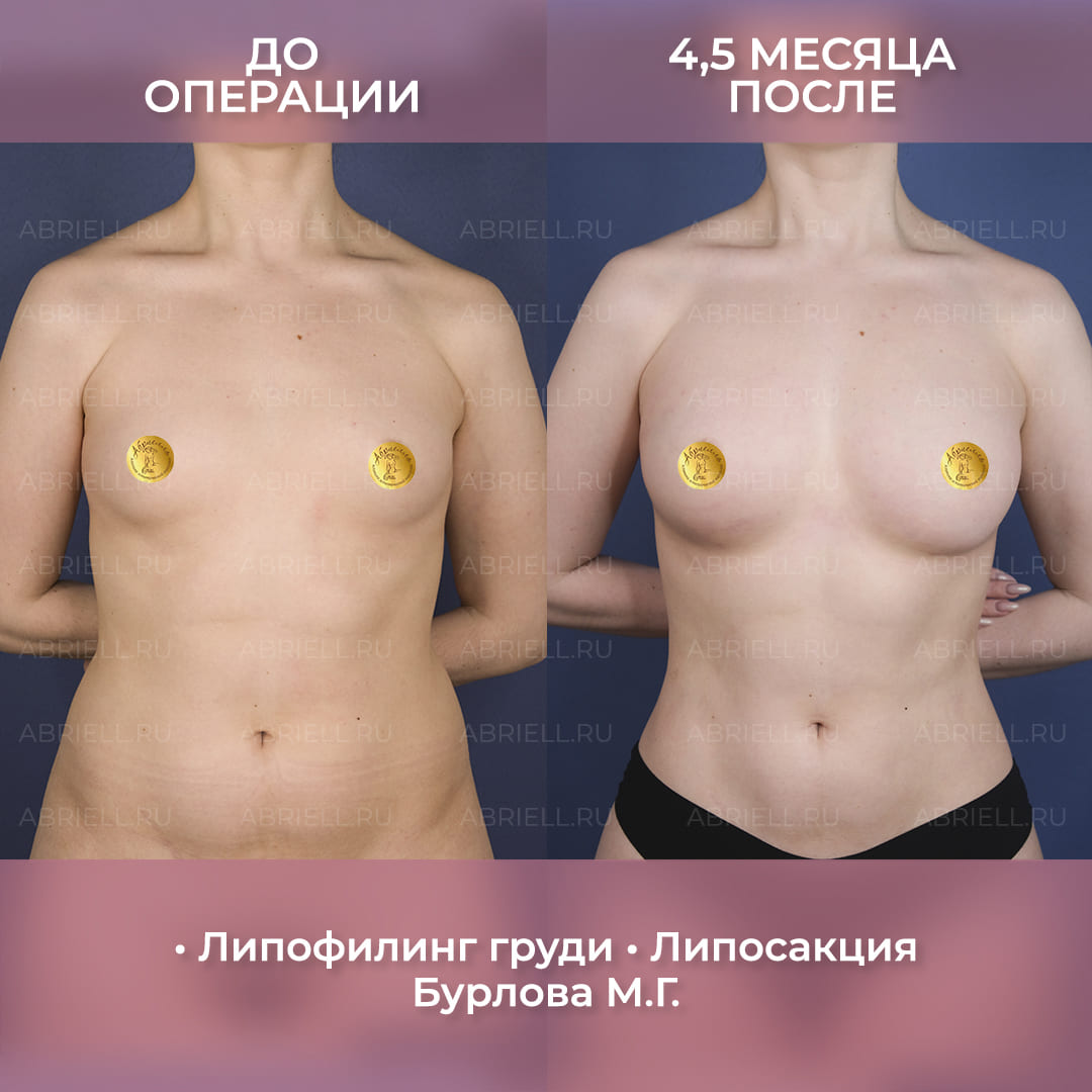 результаты липофилинга груди