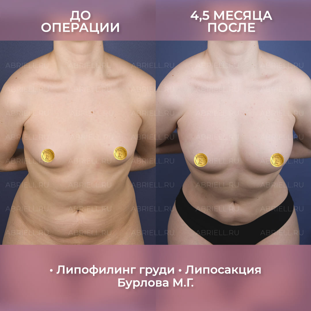 результаты липофилинга груди