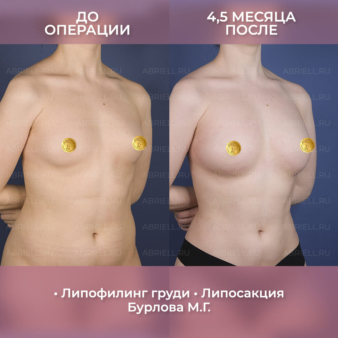 результаты липофилинга груди