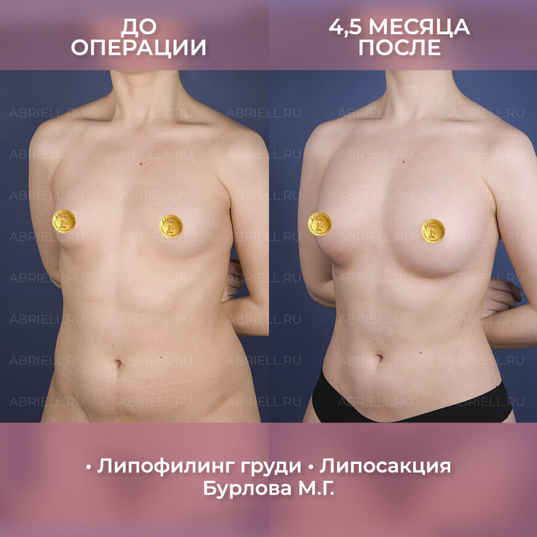 результаты липофилинга груди