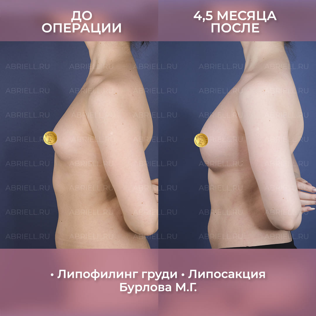 результаты липофилинга груди