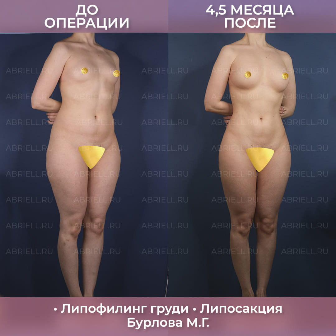 результаты липофилинга груди