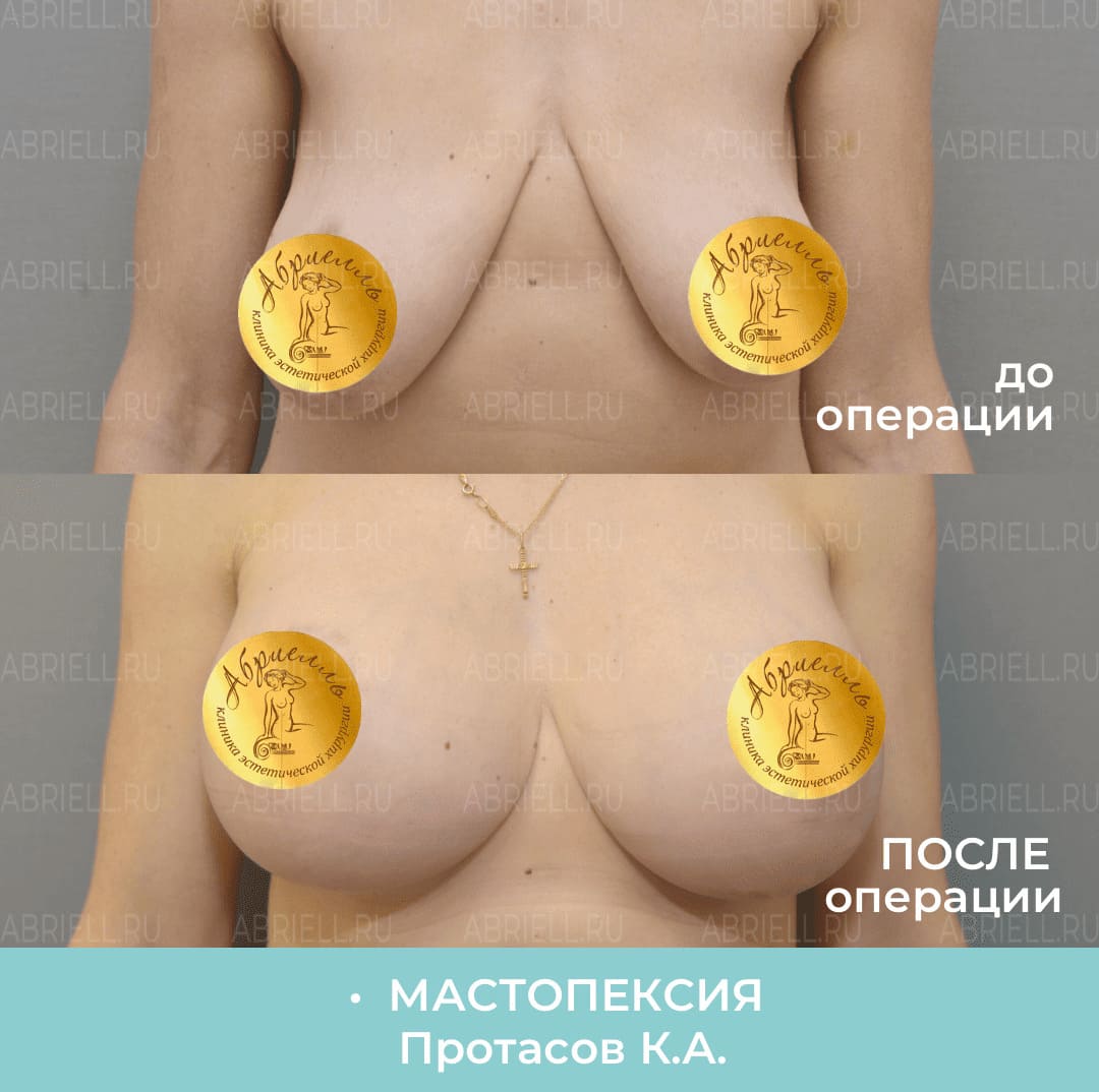 Фото до и после мастопексии
