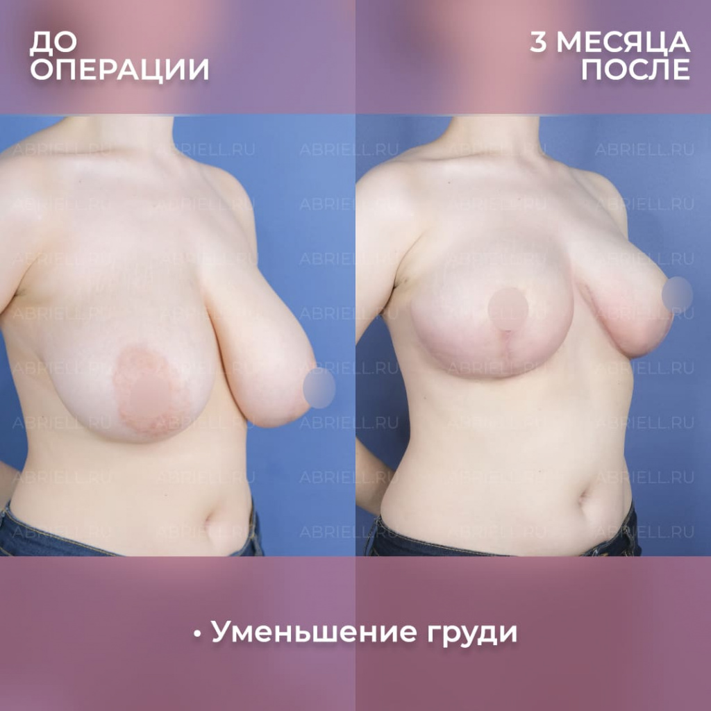 Результат пластической операции у Евлаховой Натальи Алексеевны